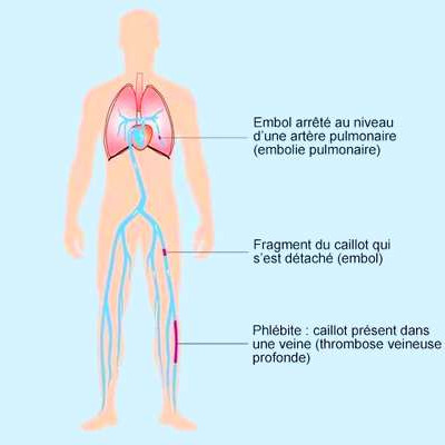 La Somme plutt peu concerne par les embolies pulmonaires - EVASION