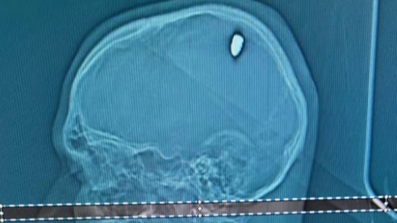 Sa gueule de bois était en fait dûe... à une balle de 9mm